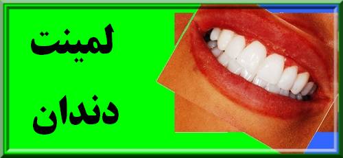 آنچه هنگام قرار دادن لمینت باید بدانید