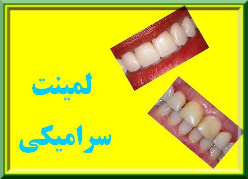 لمینت سرامیکی