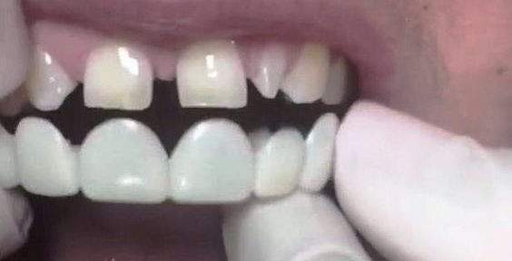 عمر لمینت متحرک دندان