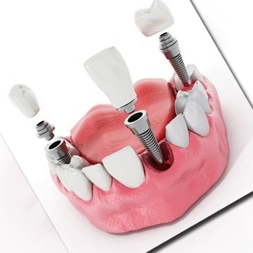 آیا ایمپلنت دندان می تواند موثر باشد