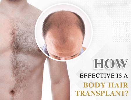 کاشت مو به روش BHT از موهای بدن,bht hair transplant,کاشت مو از بدن, بهترین قسمت بدن برای کاشت مو به روش BHT, مراقبت های لازم برای کاشت مو به روش BHT,مزایای کاشت مو به روش BHT,کاشت مو از موهای بدن,
