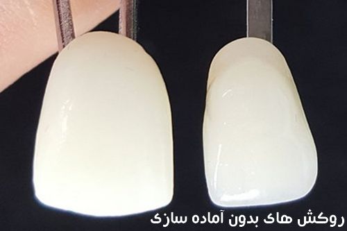 روکش های بدون آماده سازی