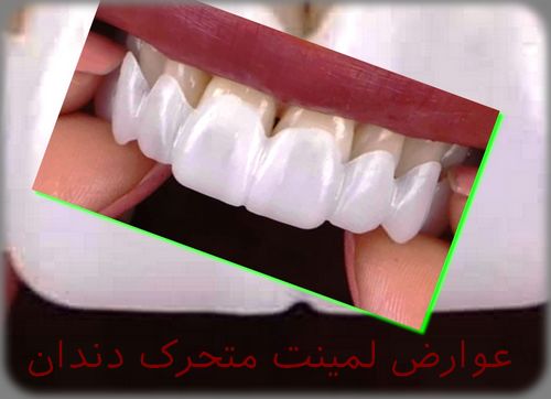 عوارض استفاده از لمینت متحرک دندان و مضرات آن چیست + جلوگیری