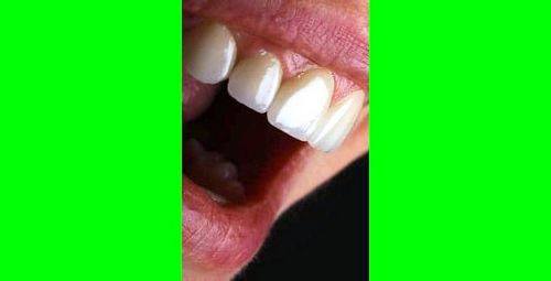 آماده سازی  لمینت دندان چگونه است