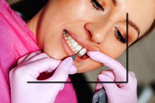معایب روکش های دندانی