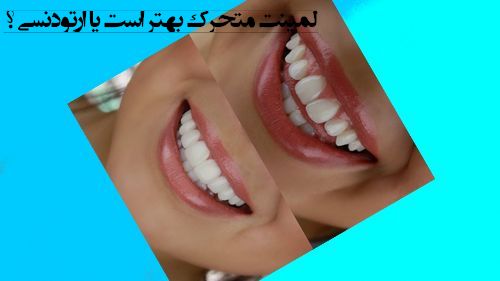 برای دندان کج لمینت متحرک بهتر است یا ارتودنسی ؟