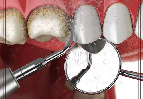 روش جرم گیری دندان لمینت شده چگونه است 