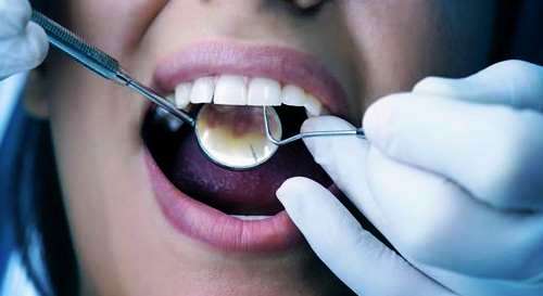 لمینت جنس سرامیک دوراتین چیست 