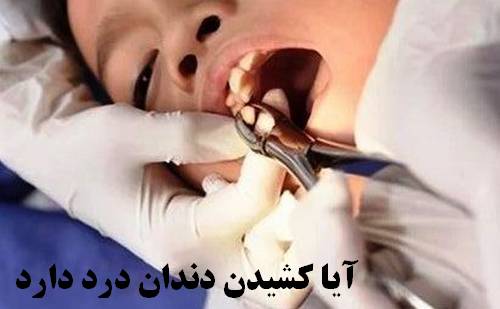 آیا کشیدن دندان آسیاب درد دارد