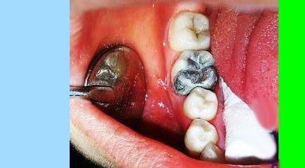 روکش دندان بعد از عصب کشی