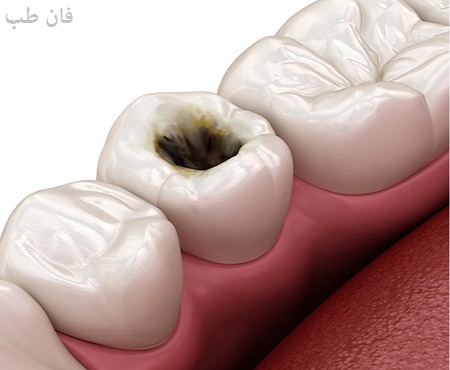 پیشگیری و درمان عفونت دندان روکش شده