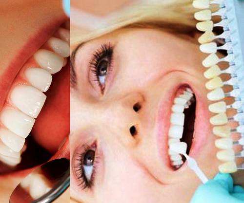 لمینت دندان یا کامپوزیت کدام را انتخاب کنم مساله کدام است این یا اون