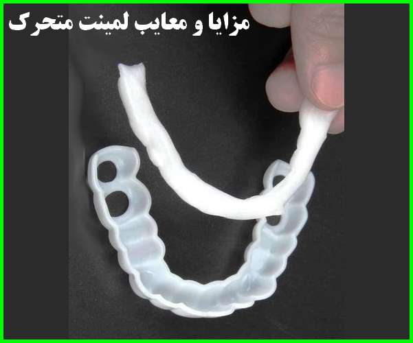 مزایا و معایب اصلی لمینت دندان