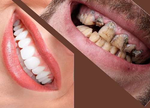 آیا برای لمینت دندان اصلی باید سالم باشد