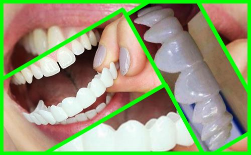 آیا لمینت متحرک برای دندان ضرر دارد