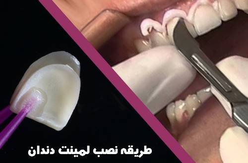 نحوه انجام لمینت دندان